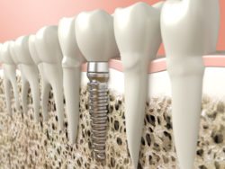 dental implants Indianapolis IN