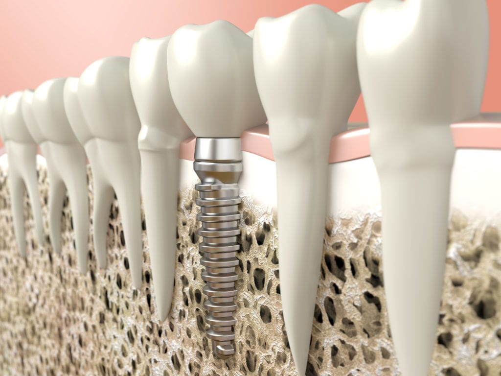 Affordable teeth Implants in Indianapolis IN