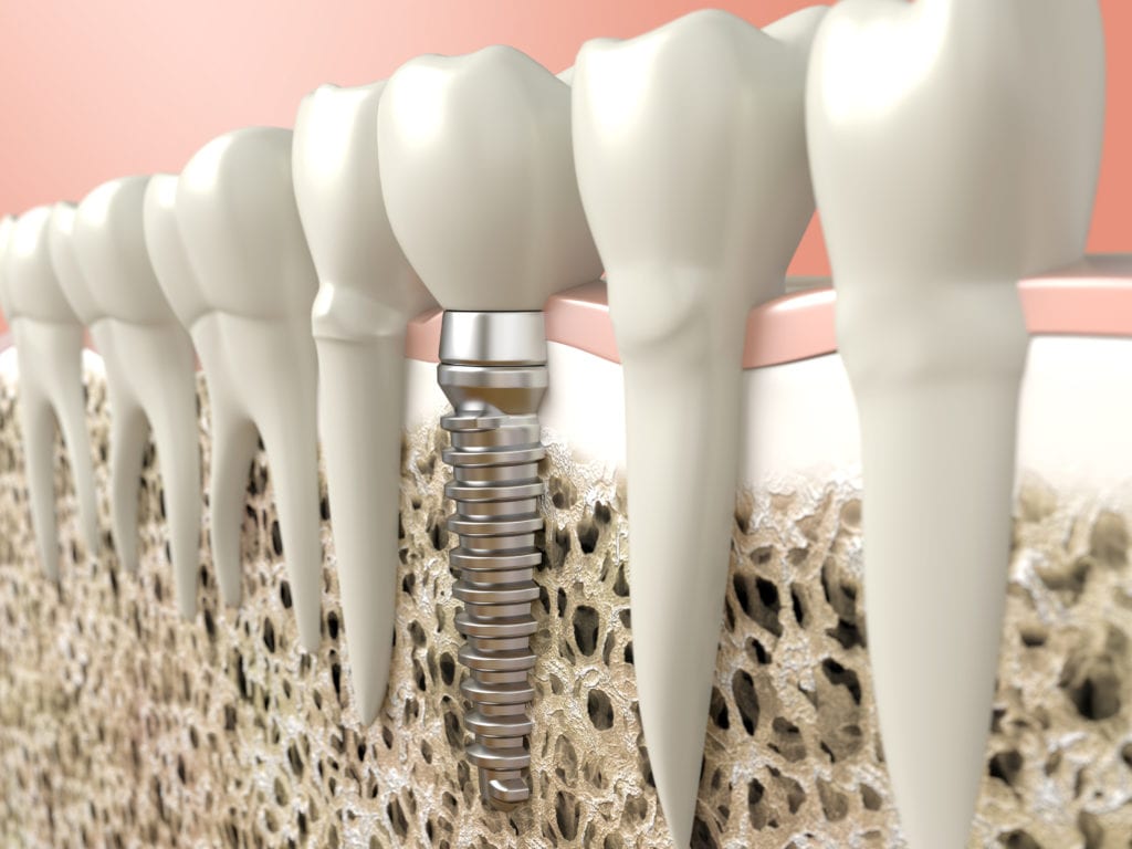 Dental Implant Procedure Indianapolis IN Teeth Implants