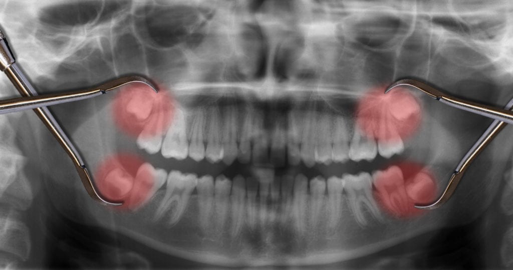 Wisdom teeth extractions in Indianapolis Indiana
