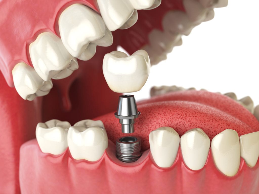 dental implants can replace missing teeth in Indianapolis Indiana
