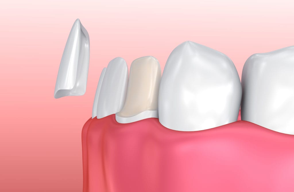 Affordable porcelain veneers in Indianapolis Indiana