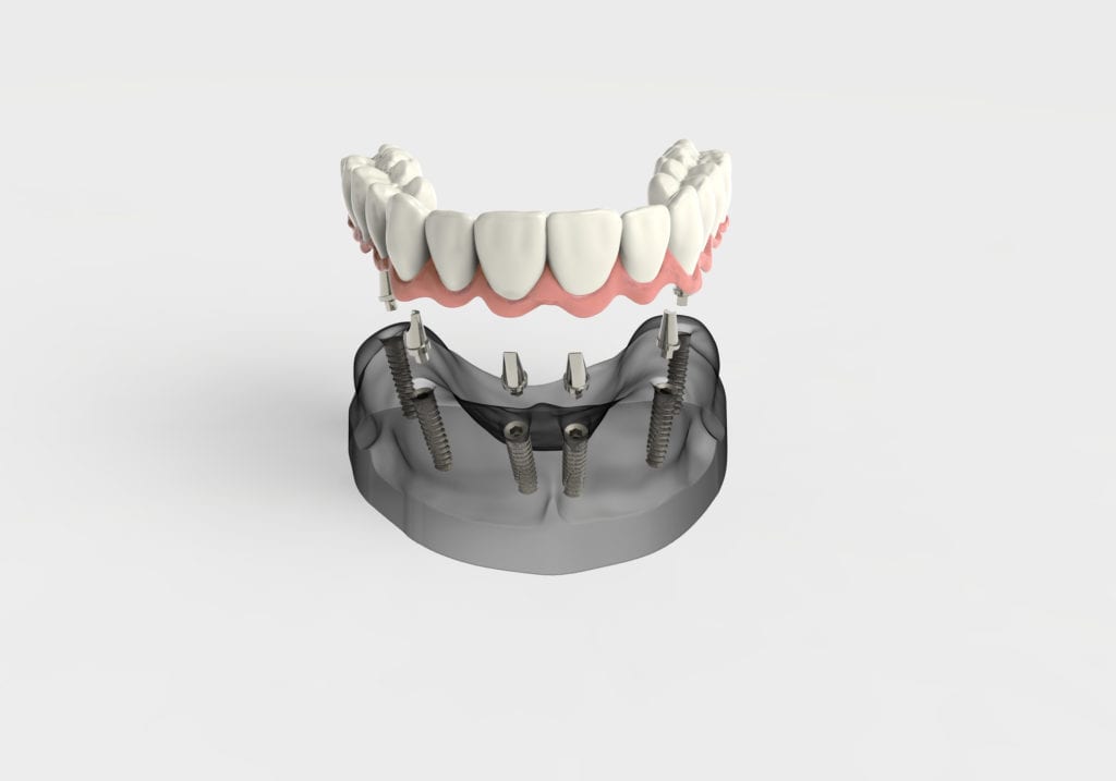 Affordable All-on-four implant Dentures in Indianapolis