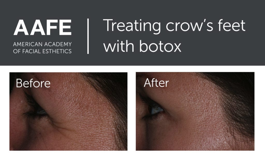 botox for crows feet in Indianapolis Indiana