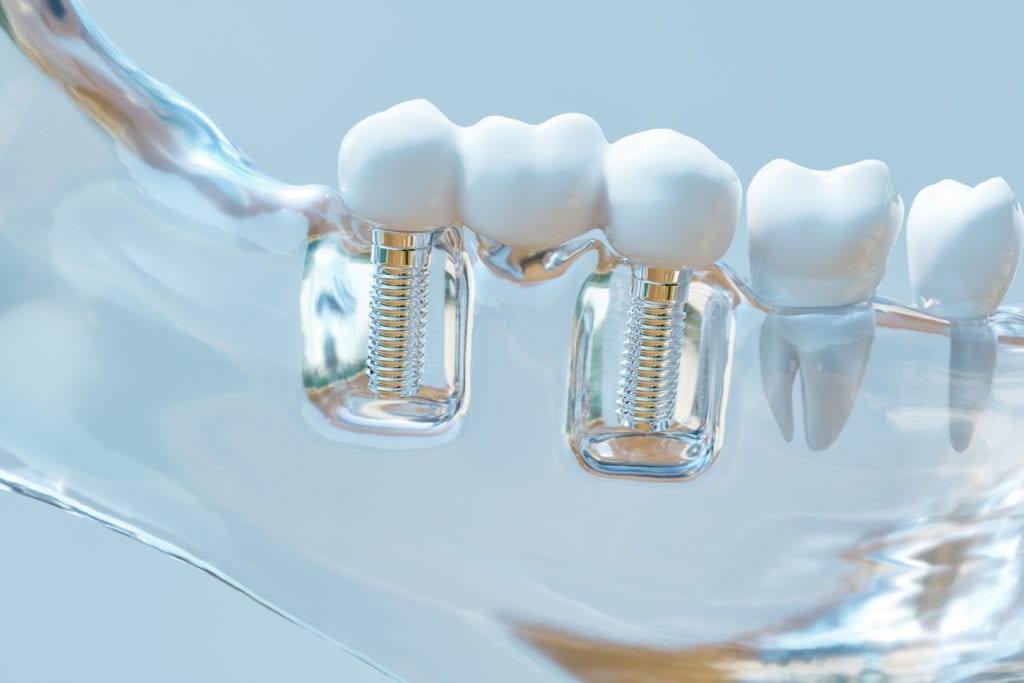 3D Rendering of dental implant in Indianapolis