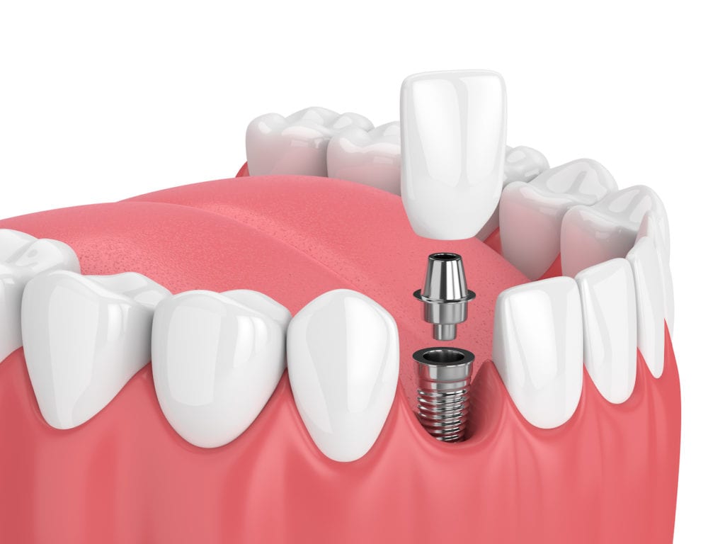One dental implant for a single missing tooth