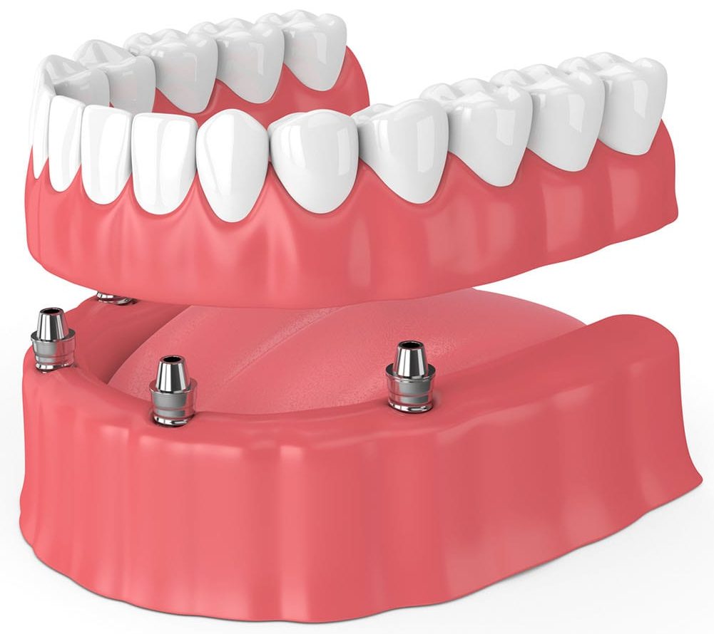 Dental Implants vs Dentures in Indianapolis Indiana