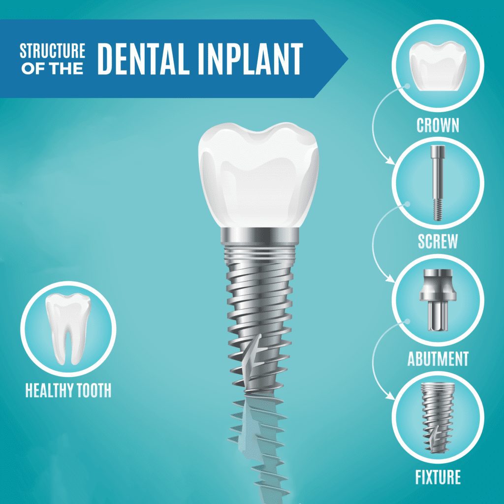 Structure of the dental implant with implant dentist in Indianapolis IN
