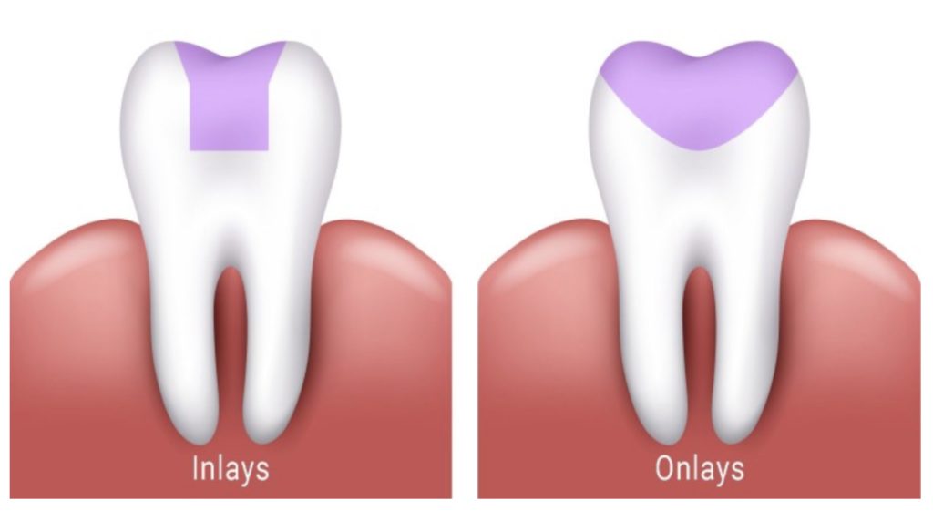 Dental inlays and onlays