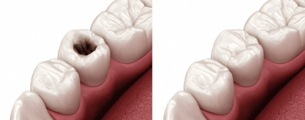 3d image of cavity before and after filling process dental filling dentist in Indianapolis Indiana