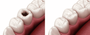 3d image of cavity before and after filling process dental filling dentist in Indianapolis Indiana