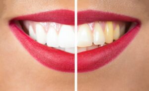 side-by-side image of a smile before and after a whitening treatment cosmetic dentistry dentist in Indianapolis Indiana