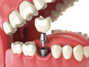 Dental Implants After Gum Disease