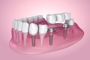 dental implants in Indianapolis, IN