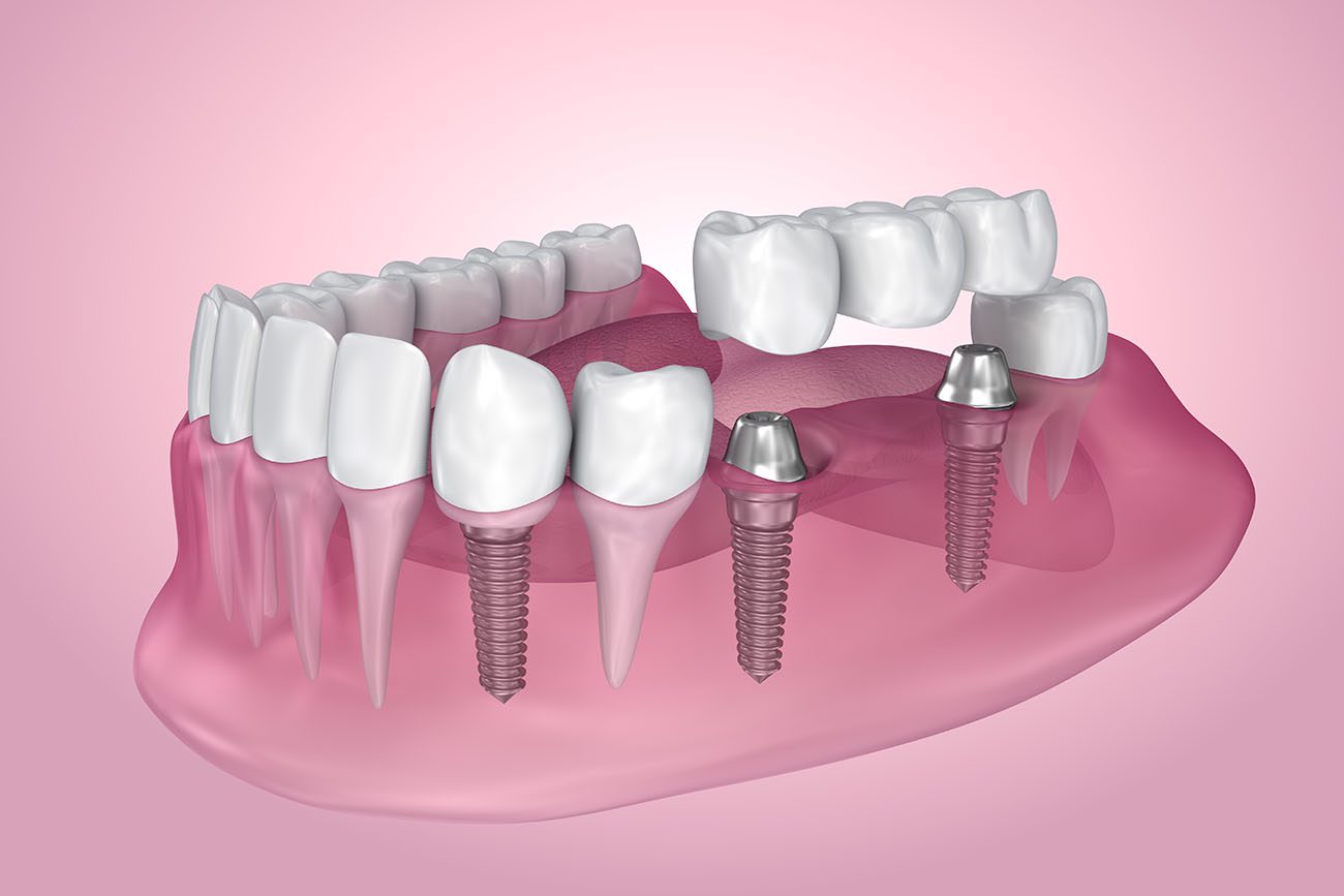  The Advantages of Dental Implants in Indianapolis, IN