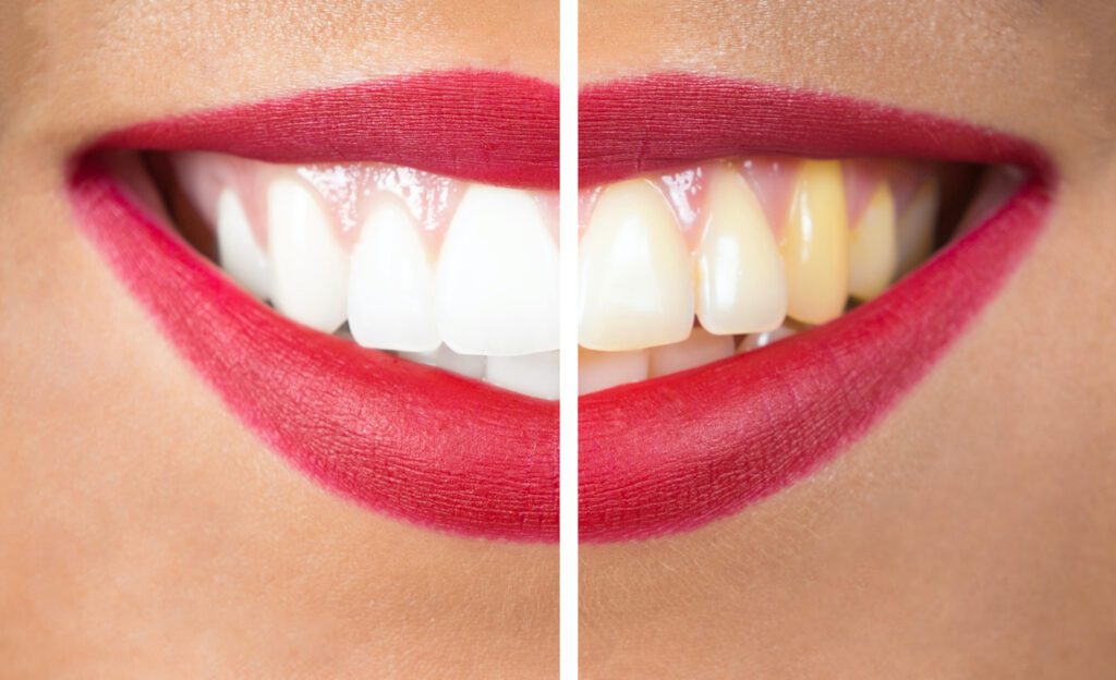 This article will explore whether teeth whitening is right for you, considering various factors and types of whitening options available.