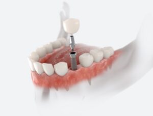 dental implants in Indianapolis, IN