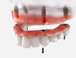 Implant-supported dentures in Indianapolis, IN