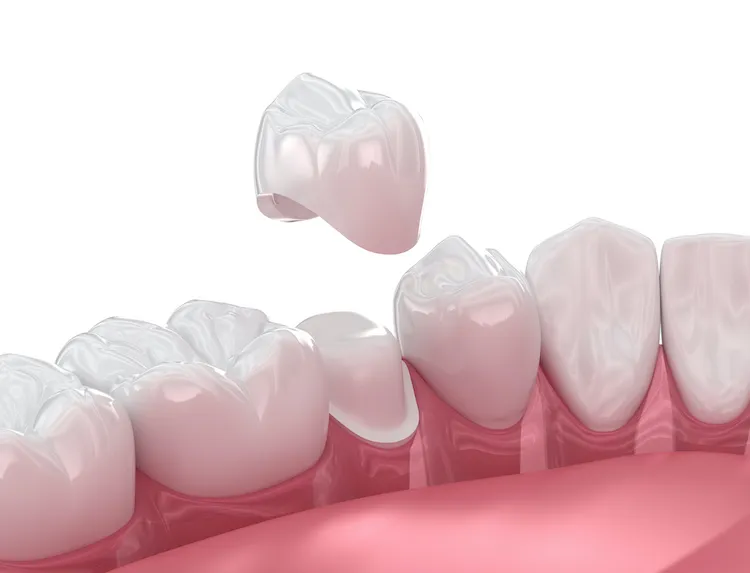 Aftercare for a Dental Crown in Indianapolis, IN