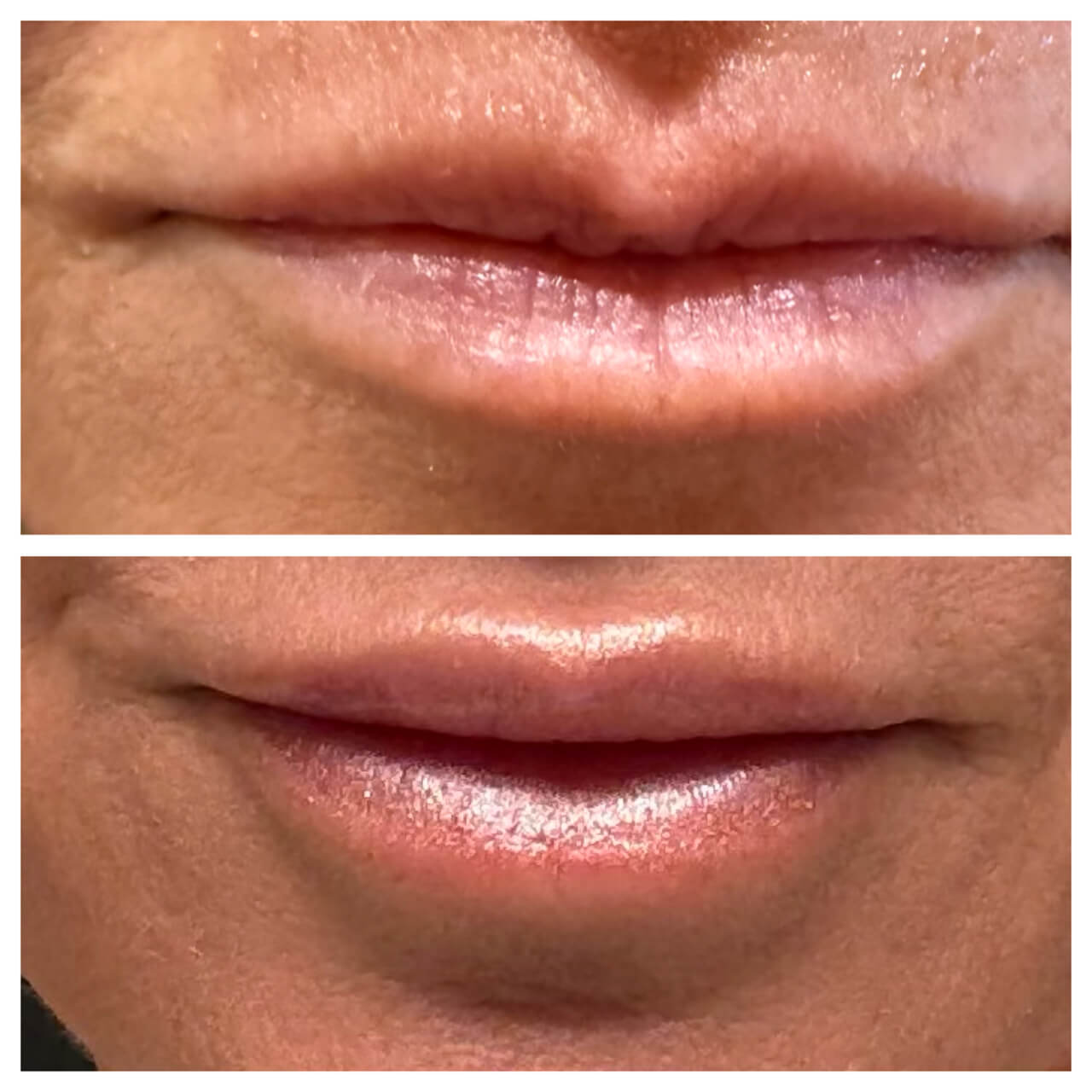 Dermal_Fillres_01
