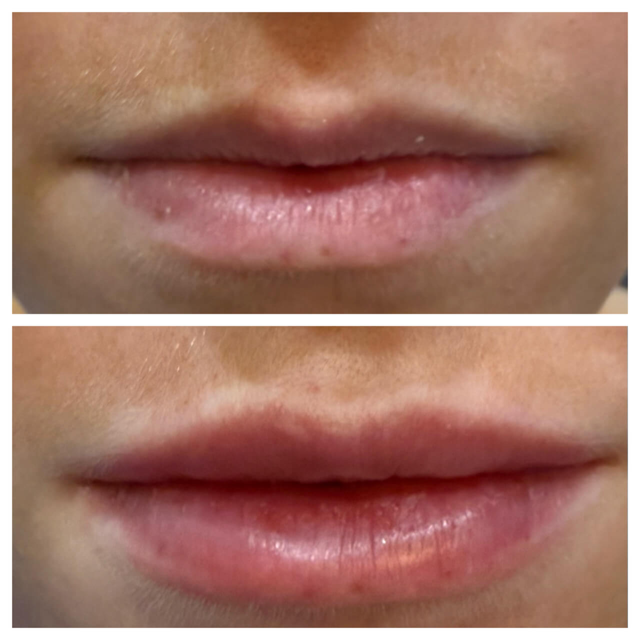 Dermal_Fillres_02