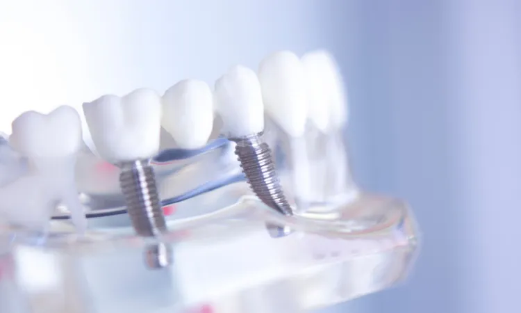 Dental Implants vs. Dental Bridges in Indianapolis, IN